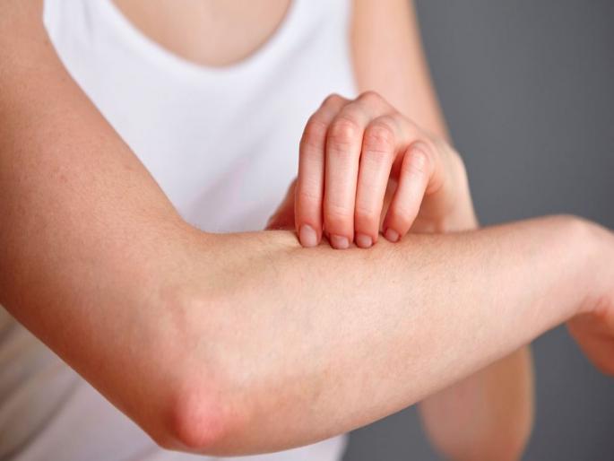 Omicron Symptoms : Skin rashes that can show on your skin hives prickly heat chilblains | Omicron Symptoms : त्वचेवर दिसणारे हे निशाण आहे ओमायक्रॉनची लक्षणं, अजिबात करू नका दुर्लक्ष Omicron Symptoms : Skin rashes that can show on your skin hives prickly heat chilblains | Omicron Symptoms : त्वचेवर दिसणारे हे निशाण आहे ओमायक्रॉनची लक्षणं, अजिबात करू नका दुर्लक्ष
