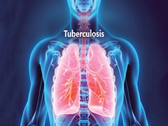 World Tuberculosis Day 2022 : Know the Symptom, causes, treatment | World Tuberculosis Day 2022 : टीबीच्या या सामान्य लक्षणांकडे करू नका दुर्लक्ष, वाढू शकतो धोका World Tuberculosis Day 2022 : Know the Symptom, causes, treatment | World Tuberculosis Day 2022 : टीबीच्या या सामान्य लक्षणांकडे करू नका दुर्लक्ष, वाढू शकतो धोका
