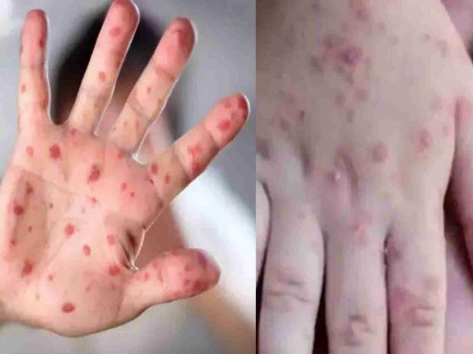 What is hand foot mouth disease in children? Know the symptoms | काय आहे लहान मुलांना होणारा 'हँड फूट माउथ' आजार? ज्यामुळे सध्या हैराण झालेत पालक What is hand foot mouth disease in children? Know the symptoms | काय आहे लहान मुलांना होणारा 'हँड फूट माउथ' आजार? ज्यामुळे सध्या हैराण झालेत पालक