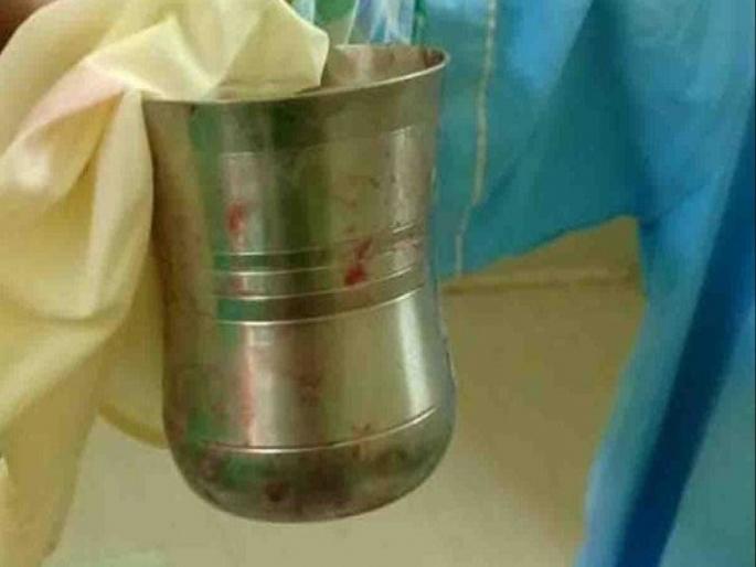 OMG! Doctor removed steel glass from stomach of Jaunpur man | डॉक्टरांनी रूग्णाच्या पोटातून काढला स्टीलचा मोठा ग्लास, आत कसा गेला वाचाल तर चक्रावून जाल! OMG! Doctor removed steel glass from stomach of Jaunpur man | डॉक्टरांनी रूग्णाच्या पोटातून काढला स्टीलचा मोठा ग्लास, आत कसा गेला वाचाल तर चक्रावून जाल!
