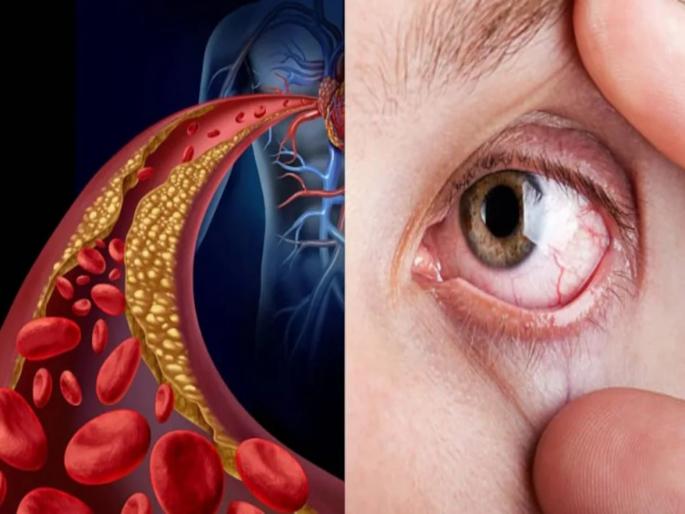 High cholesterol symptoms : You can see in your eyes eat canned beans to lower bad cholesterol | डोळ्यांमध्ये दिसतात Cholesterol वाढल्याची ही 3 लक्षणं, दुर्लक्ष करणं जीवावर बेतू शकतं!