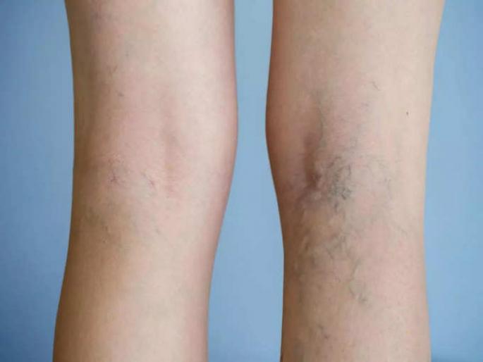 Ayurveda doctor Rekha explain what is varicose veins causes, symptoms and ayurvedic treatment | पायांच्या नसा फुगलेल्या आणि निळ्या दिसतात का? असू शकतं हे गंभीर कारण... Ayurveda doctor Rekha explain what is varicose veins causes, symptoms and ayurvedic treatment | पायांच्या नसा फुगलेल्या आणि निळ्या दिसतात का? असू शकतं हे गंभीर कारण...
