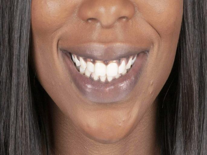 Black gums may be sign severe oral diseases know reasons black gums | तुमच्या हिरड्यांचा रंग काळा आहे का? जाणून घ्या याची कारणे.... Black gums may be sign severe oral diseases know reasons black gums | तुमच्या हिरड्यांचा रंग काळा आहे का? जाणून घ्या याची कारणे....