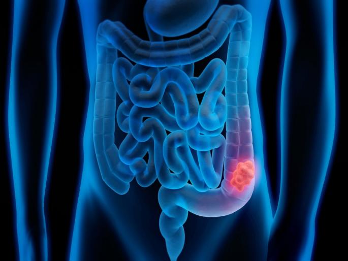 Signs your bowel cancer has spread to your bones warning symptoms of colon cancer | असे तीन संकेत जे सांगतात हाडांमध्ये पसरला आहे कॅन्सर, दुर्लक्ष करणं पडू शकतं महागात Signs your bowel cancer has spread to your bones warning symptoms of colon cancer | असे तीन संकेत जे सांगतात हाडांमध्ये पसरला आहे कॅन्सर, दुर्लक्ष करणं पडू शकतं महागात