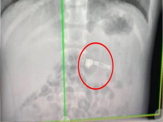Women ate apple ipod thinking it as a medicine doctor shock after seeing x-ray | औषध समजून महिलेने गिळला Apple आयपॉड, पोटातून येऊ लागला होता आवाज... Women ate apple ipod thinking it as a medicine doctor shock after seeing x-ray | औषध समजून महिलेने गिळला Apple आयपॉड, पोटातून येऊ लागला होता आवाज...