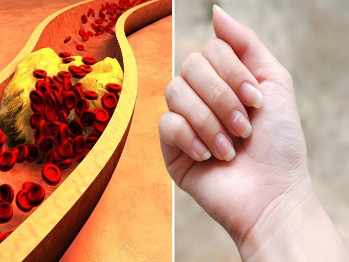 These symptoms are seen in the nails when cholesterol increases | शरीरात कोलेस्ट्रॉल वाढल्यावर नखांवर दिसतात हे संकेत, चुकूनही करू नका दुर्लक्ष These symptoms are seen in the nails when cholesterol increases | शरीरात कोलेस्ट्रॉल वाढल्यावर नखांवर दिसतात हे संकेत, चुकूनही करू नका दुर्लक्ष