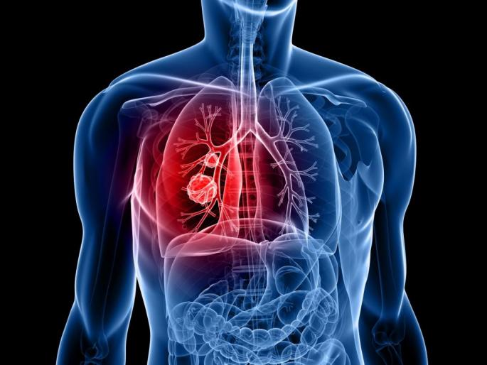 Lung cancer risk and its treatments | फुफ्फुसांचा कर्करोग आणि त्यावरील उपचारांमध्ये घडून आलेला विकास Lung cancer risk and its treatments | फुफ्फुसांचा कर्करोग आणि त्यावरील उपचारांमध्ये घडून आलेला विकास