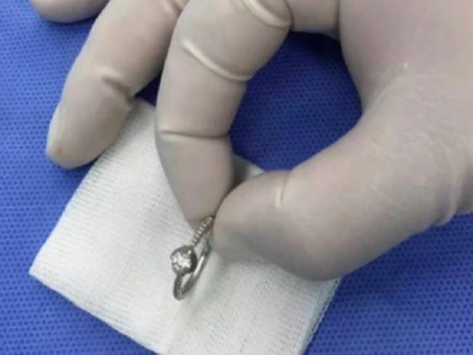Baramati: 3-year-old child swallows ring while playing, doctors save life | Baramati: खेळता-खेळता ३ वर्षीय बालकाने गिळली अंगठी, डॉक्टरांच्या तत्परतेने वाचला जीव Baramati: 3-year-old child swallows ring while playing, doctors save life | Baramati: खेळता-खेळता ३ वर्षीय बालकाने गिळली अंगठी, डॉक्टरांच्या तत्परतेने वाचला जीव