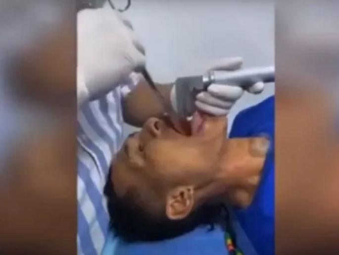 Doctor removes 7 inch fish from mans throat following a bizarre fishing accident | बापरे! मासेमारी करणं चांगलंच अंगाशी आलं, डॉक्टरांनी घश्यातून काढला ७ इंचाचा मासा, पाहा व्हिडीओ Doctor removes 7 inch fish from mans throat following a bizarre fishing accident | बापरे! मासेमारी करणं चांगलंच अंगाशी आलं, डॉक्टरांनी घश्यातून काढला ७ इंचाचा मासा, पाहा व्हिडीओ
