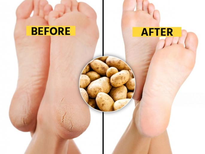 Using potatoes for cracked heels No Dry, Cracked Heels. Rub a Potato Over Them atural Home Remedies for Cracked Heels | टाचांना मोठ्या भेगा पडल्या-पावसाळ्यात ठणकतातही? कच्च्या बटाट्याचा उपाय- भेगांसाठी खास मलम...