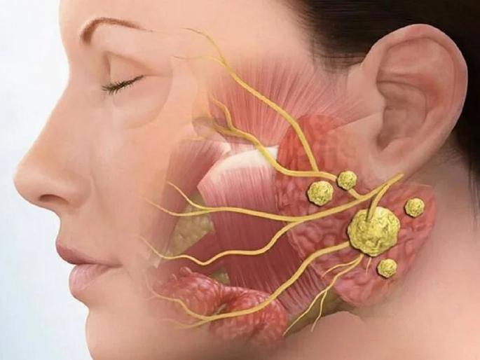 53 stones removed from Iraqi woman salivary duct in Delhi hospital | जेवण केल्यावर महिलेच्या गालावर यायची सूज, रिपोर्ट पाहून डॉक्टरांनी कपाळावर मारून घेतला हात! 53 stones removed from Iraqi woman salivary duct in Delhi hospital | जेवण केल्यावर महिलेच्या गालावर यायची सूज, रिपोर्ट पाहून डॉक्टरांनी कपाळावर मारून घेतला हात!