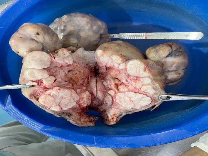 As many as 65 knots weighing 5 kg from the woman stomach Successful surgery at Lotus Hospital, Kolhapur | Kolhapur News: बाप रे...महिलेच्या पोटात ५ किलो वजनाच्या तब्बल ६५ गाठी As many as 65 knots weighing 5 kg from the woman stomach Successful surgery at Lotus Hospital, Kolhapur | Kolhapur News: बाप रे...महिलेच्या पोटात ५ किलो वजनाच्या तब्बल ६५ गाठी