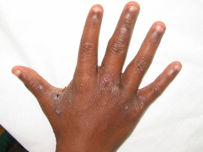 Hospital Initiative for Control Scabies | खरुजच्या नियंत्रणासाठी रुग्णालयाचा पुढाकार Hospital Initiative for Control Scabies | खरुजच्या नियंत्रणासाठी रुग्णालयाचा पुढाकार