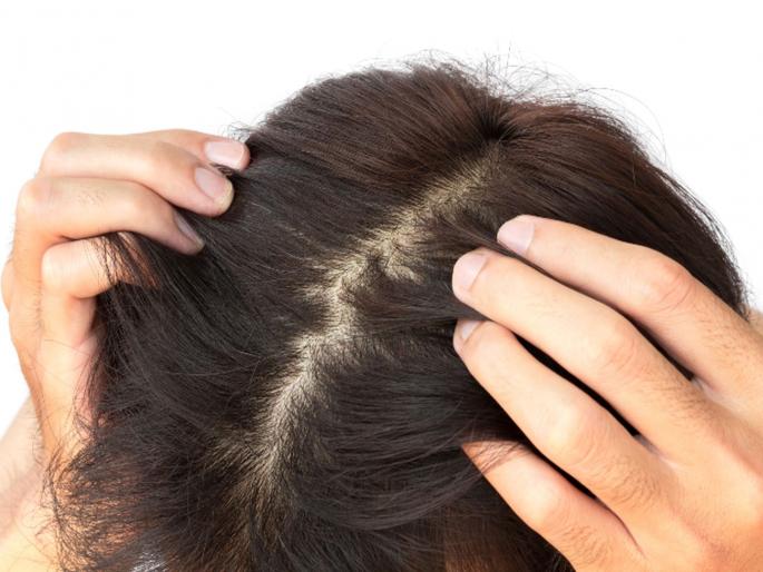 Facing itching problem in scalp try these useful home remedies | दूर करण्यासाठी घामामुळे डोक्याला होणारी खाज 'हे' ३ उपाय करा आजच्या आज! Facing itching problem in scalp try these useful home remedies | दूर करण्यासाठी घामामुळे डोक्याला होणारी खाज 'हे' ३ उपाय करा आजच्या आज!