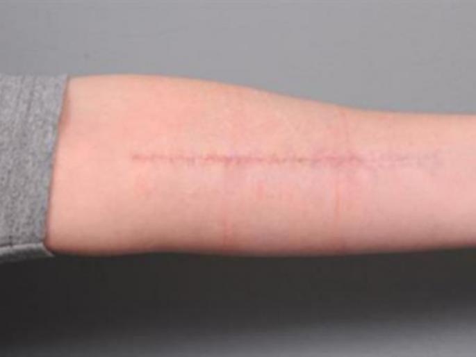 Beauty Tips : Natural home remedies to get rid of injury marks | जखमेचे किंवा जळाल्याचे डाग दूर करण्यासाठी करा हे घरगुती उपाय! Beauty Tips : Natural home remedies to get rid of injury marks | जखमेचे किंवा जळाल्याचे डाग दूर करण्यासाठी करा हे घरगुती उपाय!