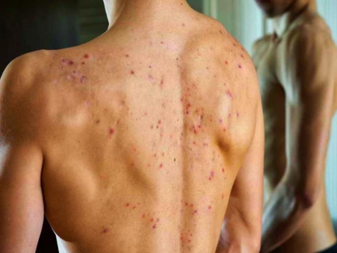 Early signs and symptoms of sepsis or septicemia causes risk factors treatment prevention | शरीरात होणारे 'हे' बदल 'सेप्सिस'ची लक्षणं असू शकतात; जाणून घ्या काय आहे 'हा' आजार Early signs and symptoms of sepsis or septicemia causes risk factors treatment prevention | शरीरात होणारे 'हे' बदल 'सेप्सिस'ची लक्षणं असू शकतात; जाणून घ्या काय आहे 'हा' आजार