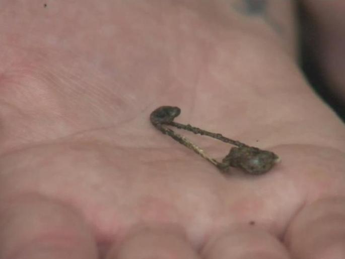 Successful Branscoscopy in Mumbai for 6 days in mumbai, Madgaon's girl | 6 दिवस सेफ्टी पीन फुफ्फुसात, मडगावच्या मुलीवर मुंबईत यशस्वी ब्रान्स्कोस्कोपी