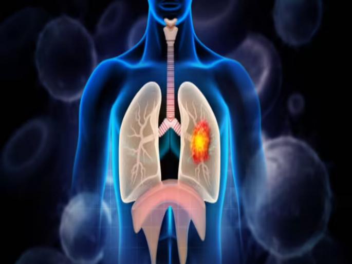 Take care of your lungs, the risk of cancer has increased; One in 74 people in India is at risk of the disease | फुप्फुस सांभाळा, कॅन्सरचे सावट वाढले; भारतात ७४ पैकी एकाला आजाराचा धोका