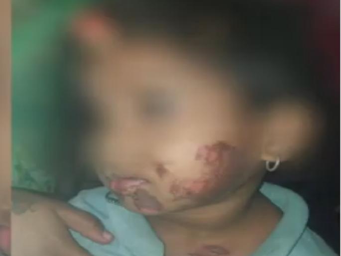 Step mother slapped daughter, shocking incident in Kolhapur district | सावत्र आईने मुलीला उलाथण्याने दिले चटके, कोल्हापूर जिल्ह्यात घडली नात्याला काळीमा फासणारी घटना Step mother slapped daughter, shocking incident in Kolhapur district | सावत्र आईने मुलीला उलाथण्याने दिले चटके, कोल्हापूर जिल्ह्यात घडली नात्याला काळीमा फासणारी घटना