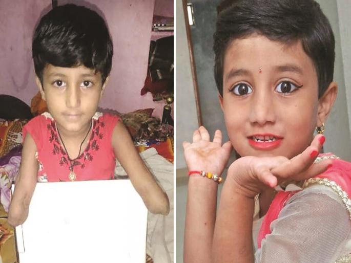 Father's struggle to regain Shruti's hand; Transplant possible, but how to spend? | श्रुतीला पुन्हा हात मिळण्यासाठी पित्याची धडपड; प्रत्यारोपण शक्य, पण खर्च कसा करणार ? Father's struggle to regain Shruti's hand; Transplant possible, but how to spend? | श्रुतीला पुन्हा हात मिळण्यासाठी पित्याची धडपड; प्रत्यारोपण शक्य, पण खर्च कसा करणार ?