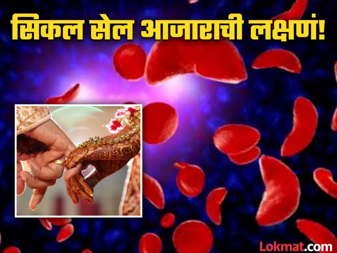 What is sickle cell disease? know the symptoms and causes | काय आहे सिकल सेल आजार? ज्यामुळे लग्न करू शकत नाहीयेत राजस्थानमधील काही लोक!  What is sickle cell disease? know the symptoms and causes | काय आहे सिकल सेल आजार? ज्यामुळे लग्न करू शकत नाहीयेत राजस्थानमधील काही लोक!