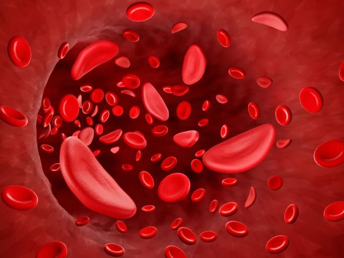 Sickle Cell: New and False Threat of Untouchability! | सिकलसेल : नवीन व खोट्या अस्पृश्यतेचा धोका! Sickle Cell: New and False Threat of Untouchability! | सिकलसेल : नवीन व खोट्या अस्पृश्यतेचा धोका!