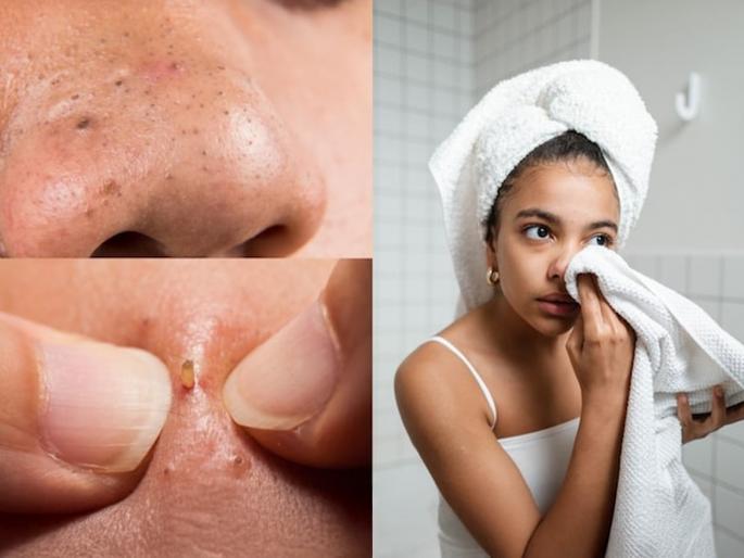 how to remove blackheads at home simple towel method for blackheads blackhead removal home remedy towel trick to remove blackheads natural way to clean blackheads natural way to clean blackheads | टॉवेलच्या मदतीने नाकावरील ब्लॅकहेड्स काढा सेकंदात! विसरा पार्लरची झंझट - त्वचा दिसेल कायम तरुण...