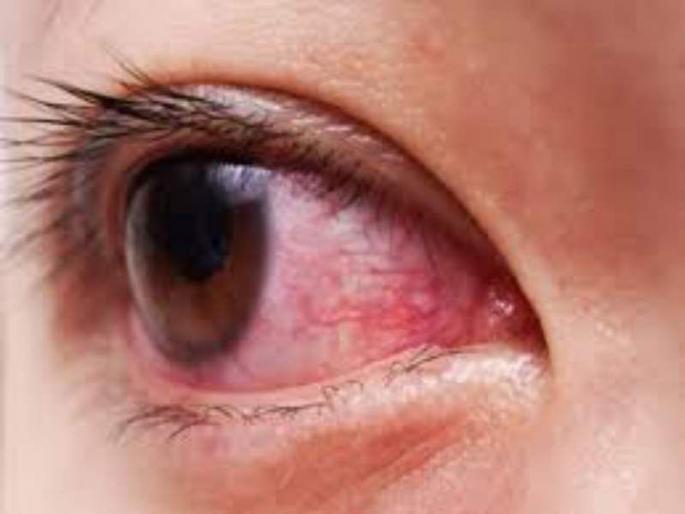 In Chhatrapati Sambhajinagar, thousands of people have eye infection in four days | छत्रपती संभाजीनगरमध्ये चार दिवसात हजारांवर नागरिकांना नेत्र संसर्ग In Chhatrapati Sambhajinagar, thousands of people have eye infection in four days | छत्रपती संभाजीनगरमध्ये चार दिवसात हजारांवर नागरिकांना नेत्र संसर्ग