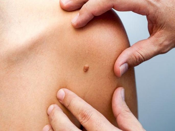 Bariatric surgery linked to reduced risk for skin cancer | लठ्ठपणा कमी करण्यासोबतच Skin Cancer चा धोका कमी करते 'ही' सर्जरी! Bariatric surgery linked to reduced risk for skin cancer | लठ्ठपणा कमी करण्यासोबतच Skin Cancer चा धोका कमी करते 'ही' सर्जरी!