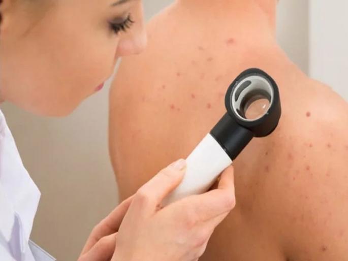 Study says Gay and Bisexual men are more likely to get skin cancer | 'या' लोकांना असतो त्वचेच्या कॅन्सरचा सर्वाधिक धोका, रिसर्चमधून आश्चर्यजनक खुलासा! Study says Gay and Bisexual men are more likely to get skin cancer | 'या' लोकांना असतो त्वचेच्या कॅन्सरचा सर्वाधिक धोका, रिसर्चमधून आश्चर्यजनक खुलासा!