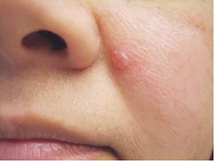 Know about Skin cancer and its causes and treatment | जाणून घ्या Skin Cancer ची कारणे आणि यासंबंधी नवा रिसर्च काय सांगतो! 