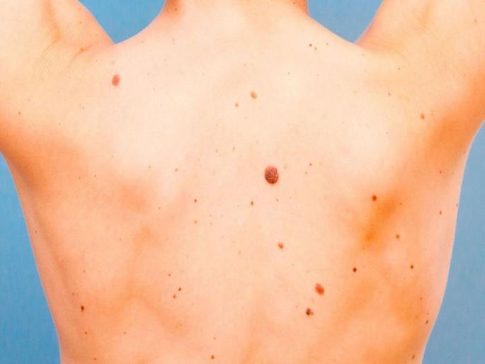 Higher vitamin a intake linked to lower skin cancer risk says study | त्वचेच्या कर्करोगापासून बचाव करायचाय?; मग 'हे' व्हिटॅमिन ठरतं फायदेशीर! Higher vitamin a intake linked to lower skin cancer risk says study | त्वचेच्या कर्करोगापासून बचाव करायचाय?; मग 'हे' व्हिटॅमिन ठरतं फायदेशीर!