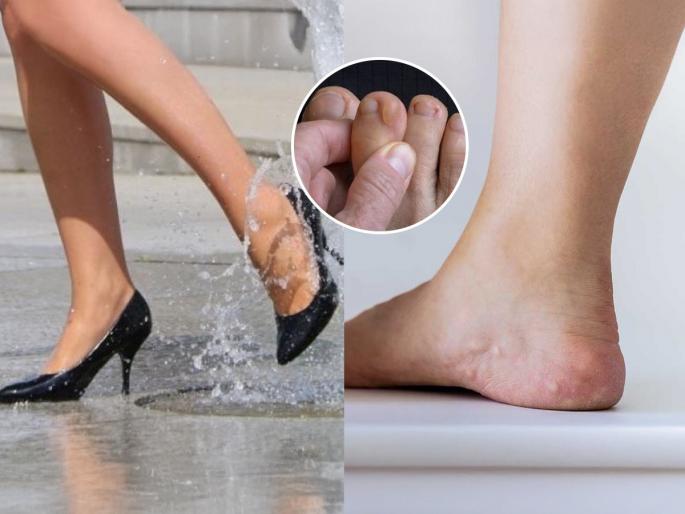 feet blister solutions, important remedies to prevent skin diseases, easy remedies , skin care at home. | पावसात पायाला चिखल्या आल्या? पावसाचे पाणी लागल्यावर लगेच करायला हवेत 'हे' उपाय, त्वचारोग टाळण्यासाठी महत्त्वाचे