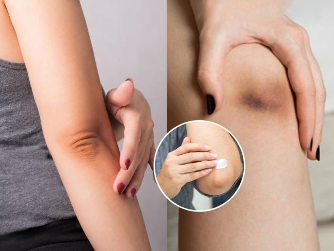 Why do your knees get so dark? These 5 habits make your skin dark, applying creams is useless until you change few things in life | गुडघे इतके काळेकुट्ट कशामुळे होतात? ‘या’ ५ सवयींमुळे काळवंडतात तुमचे गुडघे, क्रिम लावून उपयोग शून्य