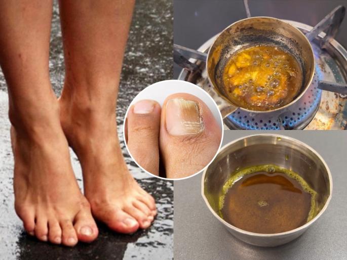 Skin & Nail Fungal Infection Homemade Oil Use During Rainy Season Rainy season skin & nail fungal infection remedy Homemade oil for leg fungal infection Foot and nail fungus home remedy How to treat fungal infection in monsoon | पावसाळ्यात पायांची त्वचा आणि नखांना फंगल इन्फेक्शन होतेच, लावा हे आयुर्वेदिक तेल - धोका टाळा...