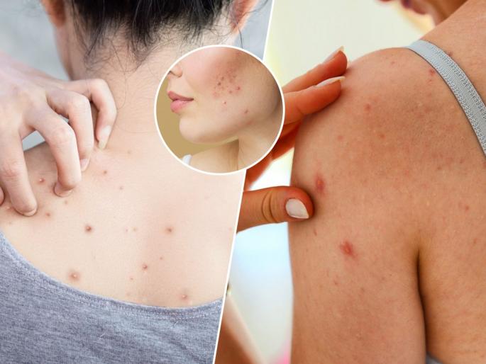 Body acne , rashes and skin problems, small problems can turn into big skin diseases | अंगावर बारीक दाणेदार पुरळ येते, खाजही सुटते? पाहा कारणं आणि उपाय-टाळा गंभीर त्वचारोग