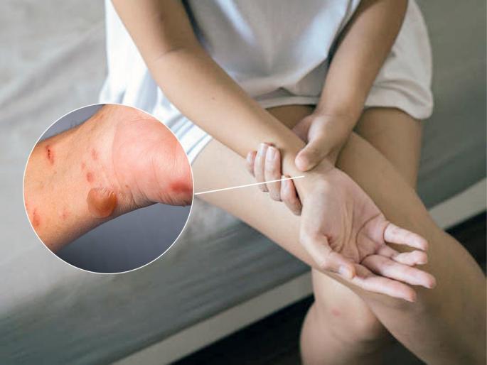 Burnt, cracked skin spots will disappear, follow this simple home remedies | भाजलेले, पोळलेले चटके बसलेले त्वचेवरचे डाग होतील गायब, करा हे सोपे उपाय