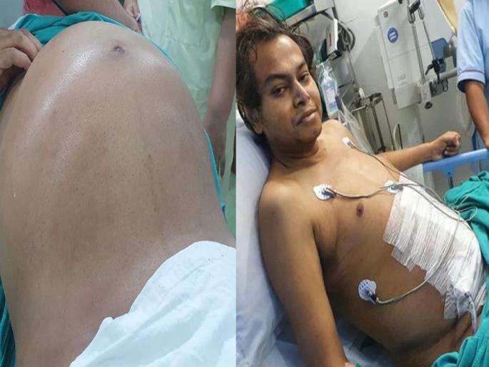 Abdominal pain for 2 months; 10 kg Tumour removed from stomach at kolkata | बापरे! २ महिन्यापासून पोटात वेदना; डॉक्टरांनी तपासल्यानंतर उघड झाला दुर्मिळ आजार Abdominal pain for 2 months; 10 kg Tumour removed from stomach at kolkata | बापरे! २ महिन्यापासून पोटात वेदना; डॉक्टरांनी तपासल्यानंतर उघड झाला दुर्मिळ आजार