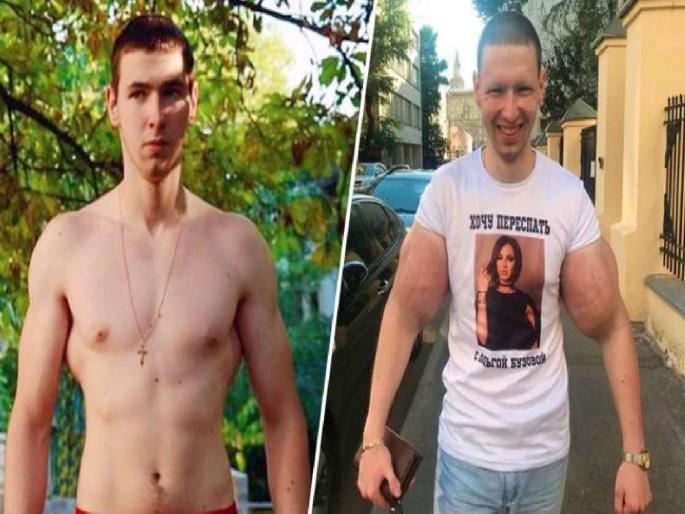 Russian bodybuilder is warned he faces 'death' unless he removes lumps of hardened petroleum jelly | झटपट बॉडी बनवण्याचा नाद जीवावर बेतला; युवकाला भलताच कारनामा नडला