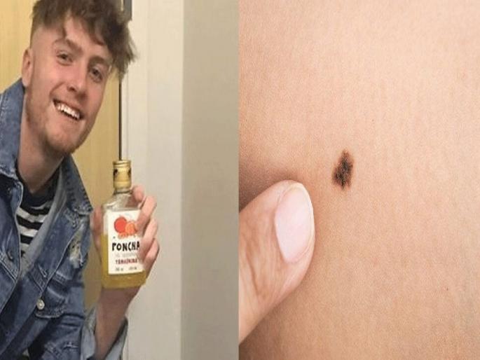 Mole developed into deadly skin cancer A 20 Year old Youth dies | शरीरावरील तीळ बनला मुलाच्या मृत्यूचं कारण; अचानक एकेदिवशी आईला कॉल आला अन्... Mole developed into deadly skin cancer A 20 Year old Youth dies | शरीरावरील तीळ बनला मुलाच्या मृत्यूचं कारण; अचानक एकेदिवशी आईला कॉल आला अन्...