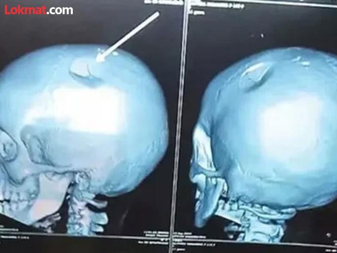 Andhra girl who was having fun was beaten by her school teacher and suffered a skull fracture | मस्ती करते म्हणून शिक्षिकेने डोक्यात घातली बॅग; कवटीला पडली खोच, सीटी स्कॅन पाहून आईला धक्का Andhra girl who was having fun was beaten by her school teacher and suffered a skull fracture | मस्ती करते म्हणून शिक्षिकेने डोक्यात घातली बॅग; कवटीला पडली खोच, सीटी स्कॅन पाहून आईला धक्का