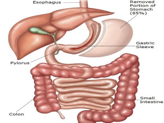 Bariatric surgery possible for needy patients; Pune Municipal Corporation | गरजू रुग्णांसाठी बॅरिअॅट्रिक शस्त्रक्रिया शक्य; पुणे महापालिकेचे सहाय्य Bariatric surgery possible for needy patients; Pune Municipal Corporation | गरजू रुग्णांसाठी बॅरिअॅट्रिक शस्त्रक्रिया शक्य; पुणे महापालिकेचे सहाय्य
