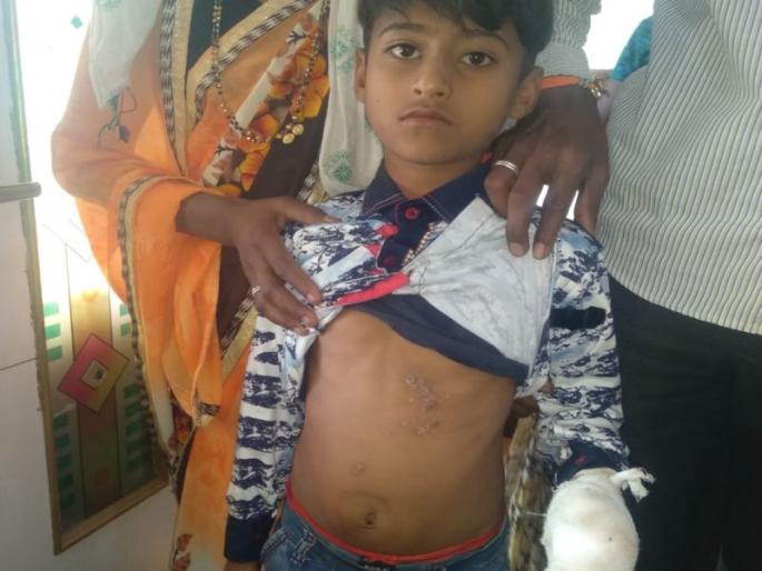 While playing games on the mobile taken in the offer, the hand of the blast, pinch was lost | ऑफरमध्ये घेतलेल्या मोबाईवर गेम खेळताना स्फोट, चिमुकल्याचा हात गमावला While playing games on the mobile taken in the offer, the hand of the blast, pinch was lost | ऑफरमध्ये घेतलेल्या मोबाईवर गेम खेळताना स्फोट, चिमुकल्याचा हात गमावला