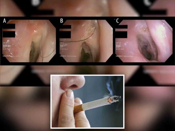 Man grows rare hair in throat after years of heavy smoking | दिवसाला सिगारेटचं एक पाकिट पित होता, घशात वाढलेले केस पाहून डॉक्टर हैराण... Man grows rare hair in throat after years of heavy smoking | दिवसाला सिगारेटचं एक पाकिट पित होता, घशात वाढलेले केस पाहून डॉक्टर हैराण...