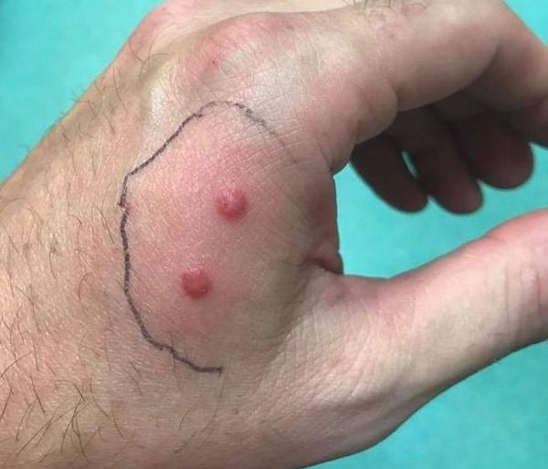 Snake bite: A natural or accident? Technical pitfalls in getting medical tratment to patients | सर्पदंश :अपघात की नैसर्गिक घटना ? रुग्णांना वैद्यकीय सेवा मिळविताना तांत्रिक पेच Snake bite: A natural or accident? Technical pitfalls in getting medical tratment to patients | सर्पदंश :अपघात की नैसर्गिक घटना ? रुग्णांना वैद्यकीय सेवा मिळविताना तांत्रिक पेच