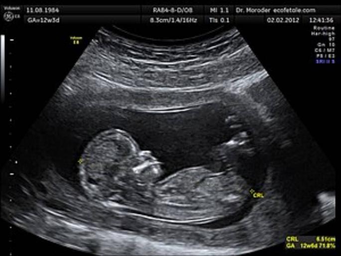 Sting operation over sonography of pregnant woman in beed area | सोनोग्राफीचा कोडवर्ड : विचारून सांगते खुरपायला कधी यायचे?