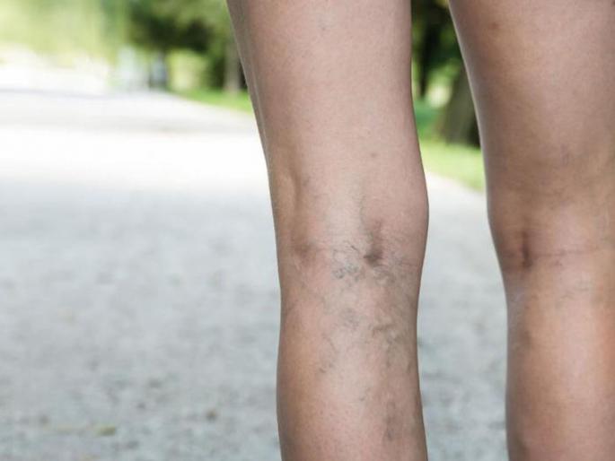 Spider veins symptoms reason and home remedy | तुमच्या पायांच्या वेदनांमागचं कारण 'स्पायडर वेन्स' तर नाही?; 'असे' करा घरगुती उपाय Spider veins symptoms reason and home remedy | तुमच्या पायांच्या वेदनांमागचं कारण 'स्पायडर वेन्स' तर नाही?; 'असे' करा घरगुती उपाय