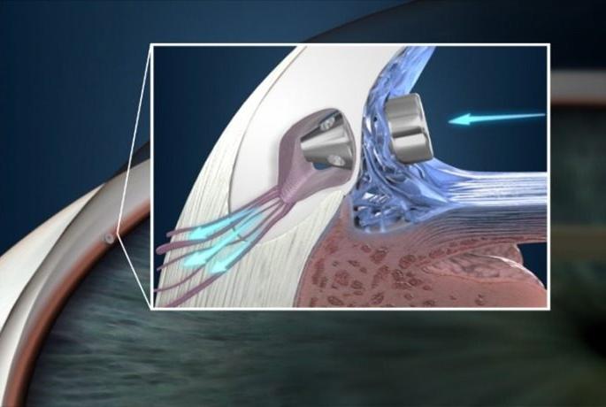Successfully passes the country's first state-of-the-art glaucoma surgery; 3 patients got new vision | देशातील पहिली अत्याधुनिक काचबिंदू शस्त्रक्रिया यशस्वीपणे पार; ३ रुग्णांना मिळाली नवी दृष्टी