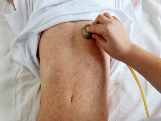 Worse than GBS syndrome; Children in Kolhapur also suffer from the serious disease of SSPE | जीबीसिंड्रोमपेक्षा भयानक; एसएसपीईच्या गंभीर आजाराची कोल्हापुरातही बालके Worse than GBS syndrome; Children in Kolhapur also suffer from the serious disease of SSPE | जीबीसिंड्रोमपेक्षा भयानक; एसएसपीईच्या गंभीर आजाराची कोल्हापुरातही बालके