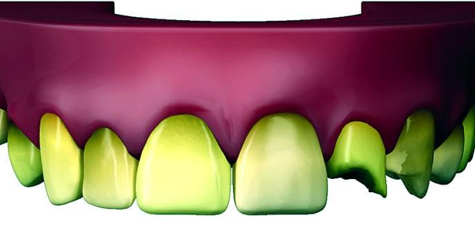 'Dental fluorosis' to 76 students in Nagpur city | नागपूर शहरातील ७६ विद्यार्थ्यांना ‘डेंटल फ्लोरोसिस’ 'Dental fluorosis' to 76 students in Nagpur city | नागपूर शहरातील ७६ विद्यार्थ्यांना ‘डेंटल फ्लोरोसिस’